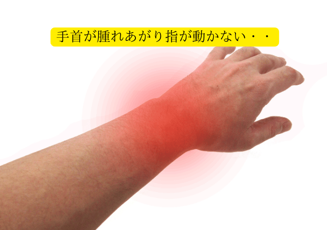 手首が腫れあがり指が動かない・・
